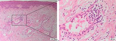 The Role of the Renin-Angiotensin System and Vitamin D in Keloid Disorder—A Review